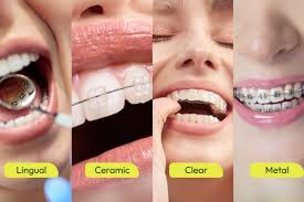 What Are the Different Types of Braces Available for Teens and Adults?